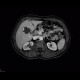 Cystic nephroma, Perlmann's tumour, hemangioma of liver: MRI - Magnetic Resonance Imaging